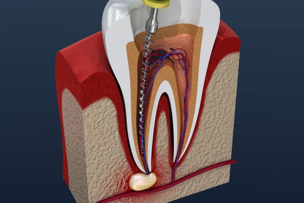 Root Canal Therapy in Mexico