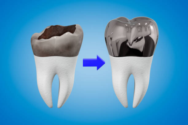 Dental Crowns in Mexico