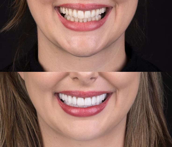 smile makeover