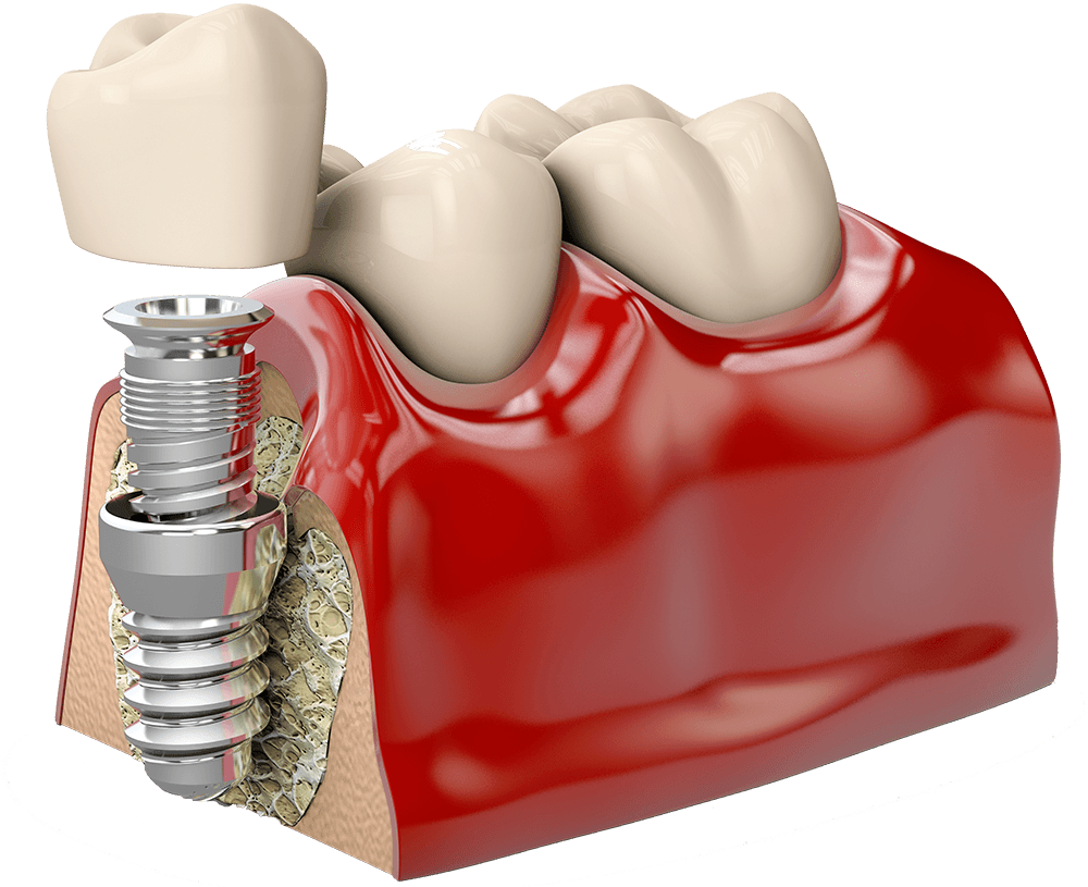 Dental implants in mexico