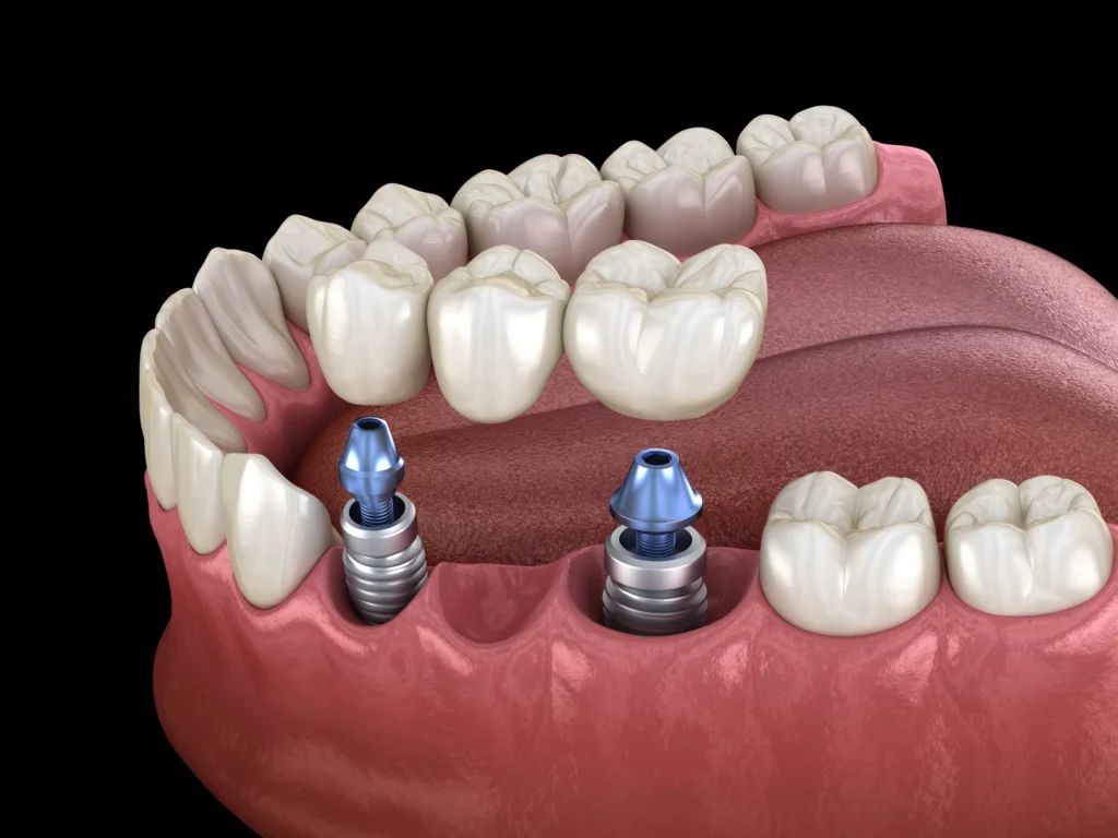 Implant-Supported Dental Bridges in Mexico