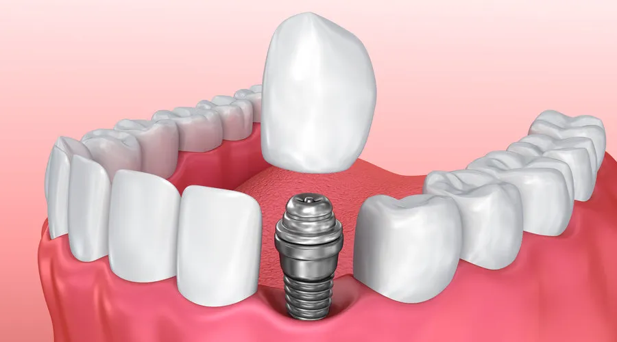 single & multiple implants