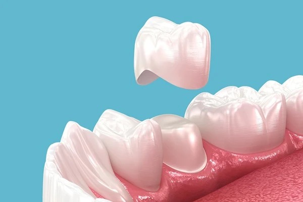 Why Choose Zirconia Crowns for Your Dental Treatment?