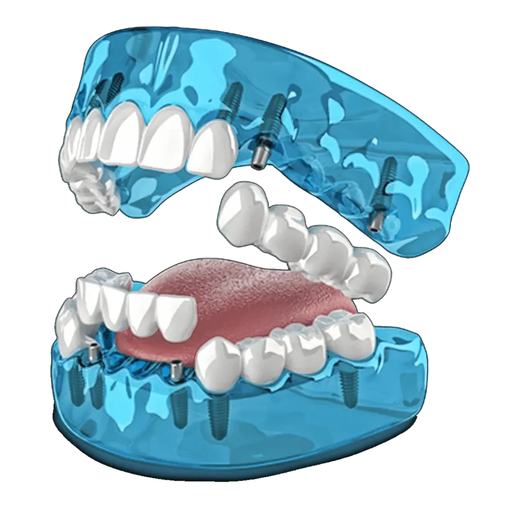 3-ON-6 dental implants mexico