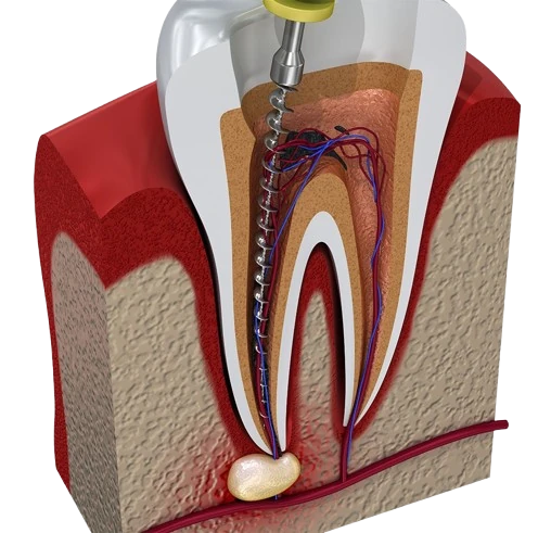 Root Canal in Mexico removebg preview