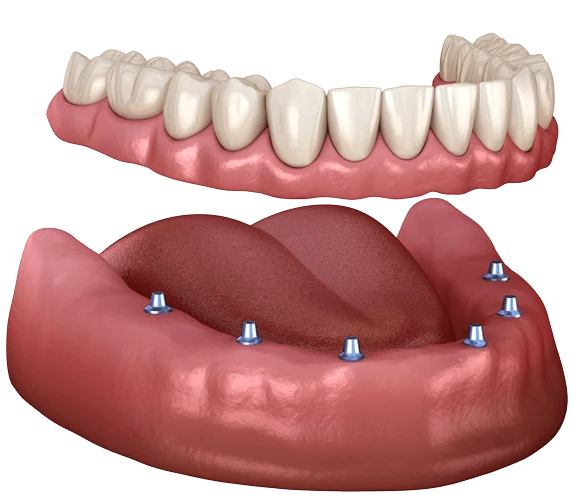 All on 6 dental implant treatment in mexico