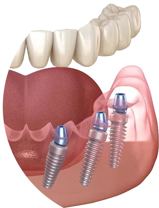 All on 6 dental implants mexico