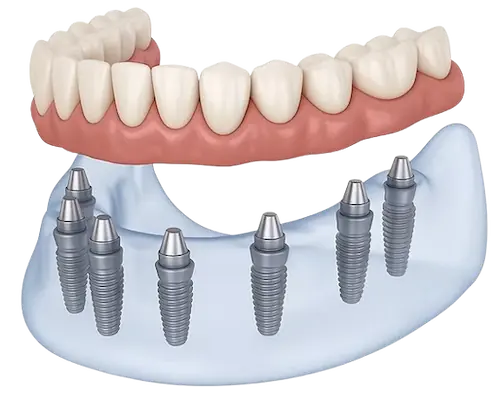 All on 8 dental implants