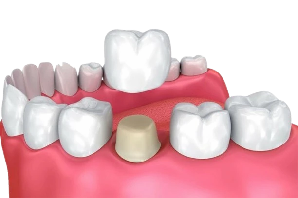 Dental crowns mexico 