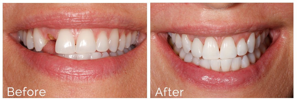 Dental implants before and after