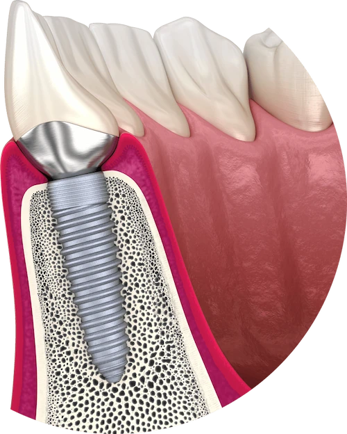 Single dental implants