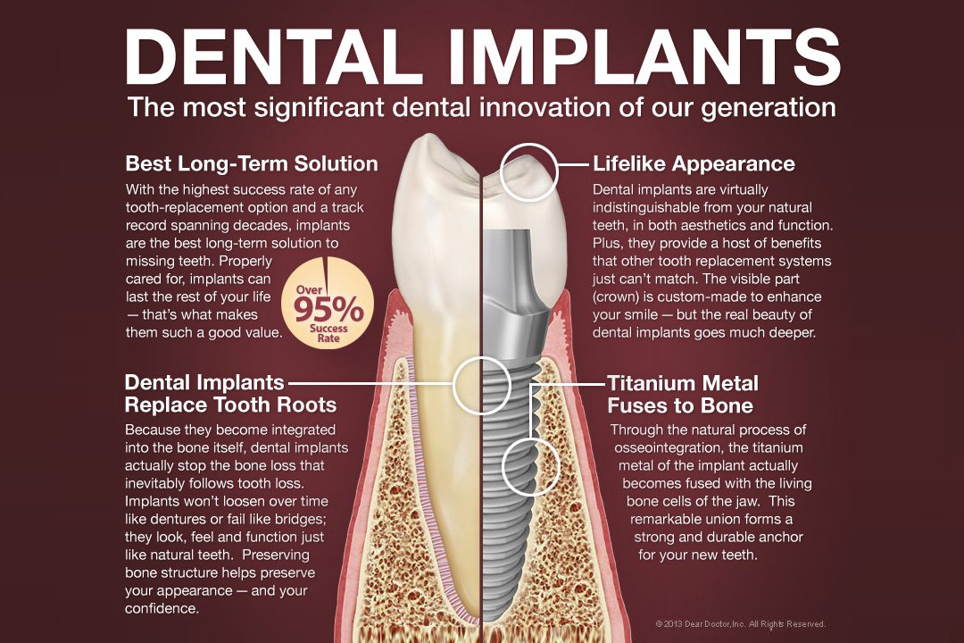 Dental implant infographic